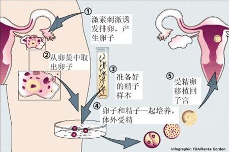取卵手术室